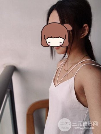 職業(yè)模特做了假體隆胸手術(shù)分享手術(shù)恢復(fù)照片