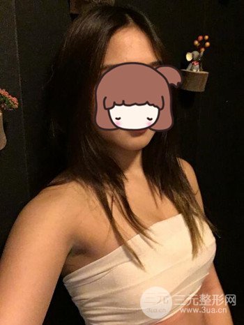 職業(yè)模特做了假體隆胸手術(shù)分享手術(shù)恢復(fù)照片