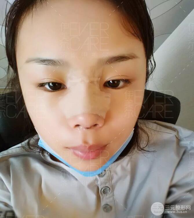 北京伊美爾徐軍假體隆鼻前后對(duì)比照片心情日記