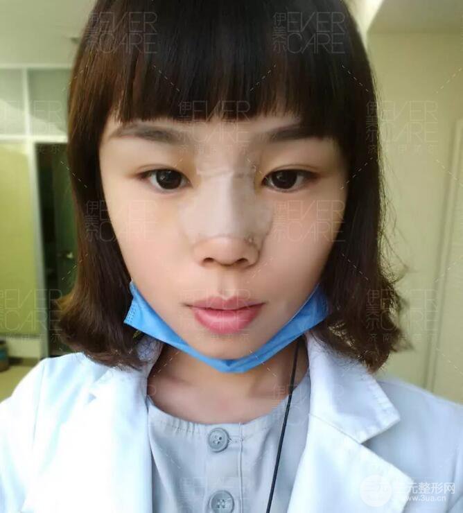 北京伊美爾徐軍假體隆鼻前后對(duì)比照片心情日記