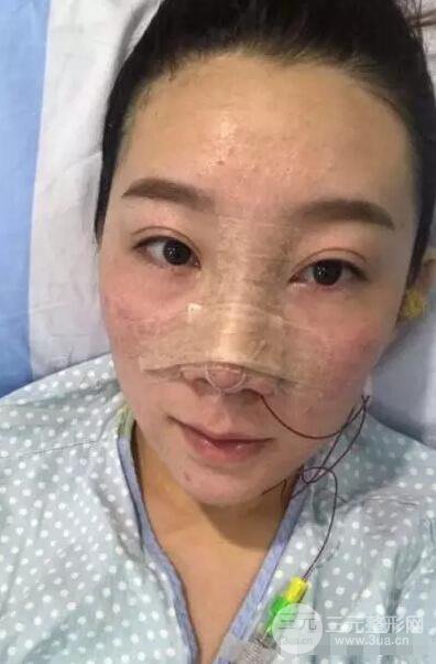 北京伊美爾徐軍隆鼻整形前后對比照片心情記錄小札