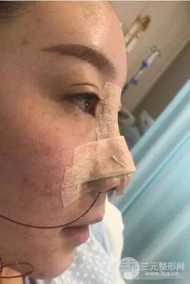 北京伊美爾徐軍隆鼻整形前后對比照片心情記錄小札