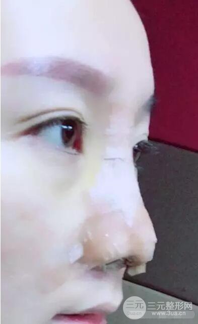 北京伊美爾徐軍隆鼻整形前后對比照片心情記錄小札