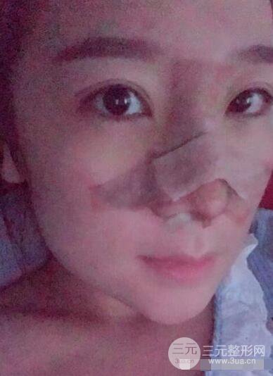 北京伊美爾徐軍隆鼻整形前后對比照片心情記錄小札