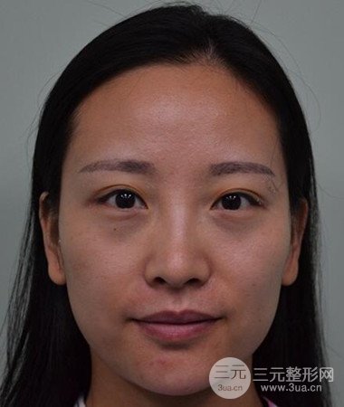 內切微創(chuàng)去眼袋手術案例分享，附上手術恢復照片