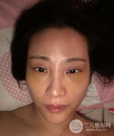 內切微創(chuàng)去眼袋手術案例分享，附上手術恢復照片