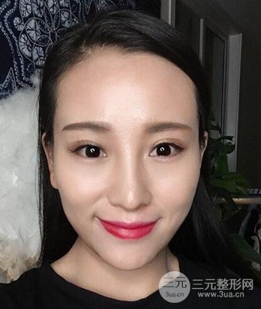 內切微創(chuàng)去眼袋手術案例分享，附上手術恢復照片