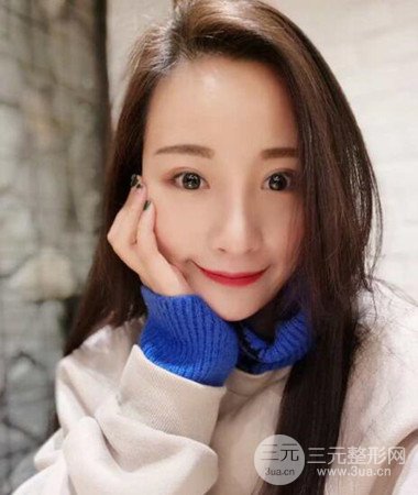 內切微創(chuàng)去眼袋手術案例分享，附上手術恢復照片