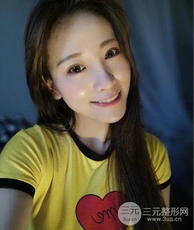 內切微創(chuàng)去眼袋手術案例分享，附上手術恢復照片