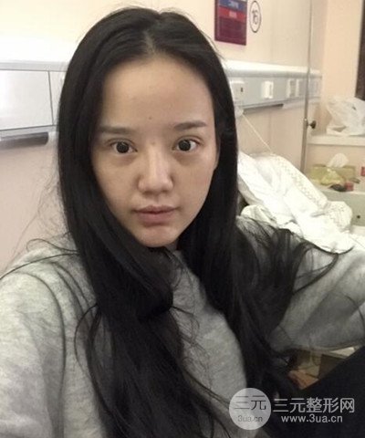 做了隆鼻整形成功落實精致小巧鼻 附上果圖