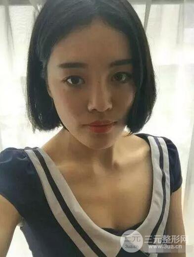 成都玉之光自體脂肪面部填充劉中國真人案例反饋|內(nèi)附對(duì)比前后照