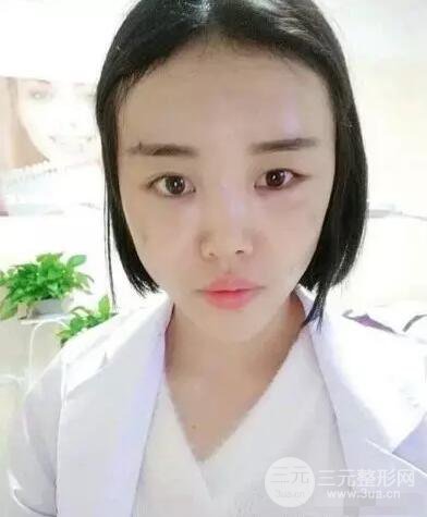 成都玉之光自體脂肪面部填充劉中國真人案例反饋|內(nèi)附對(duì)比前后照