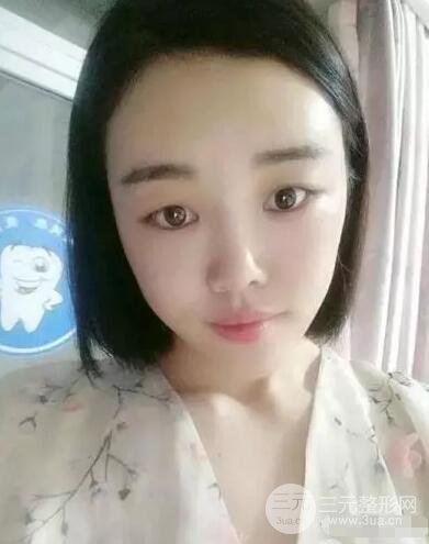 成都玉之光自體脂肪面部填充劉中國真人案例反饋|內(nèi)附對(duì)比前后照