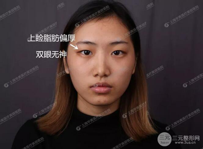 上海華美楊亞益全切雙眼皮案例對(duì)比圖 男女雙眼皮案例混搭