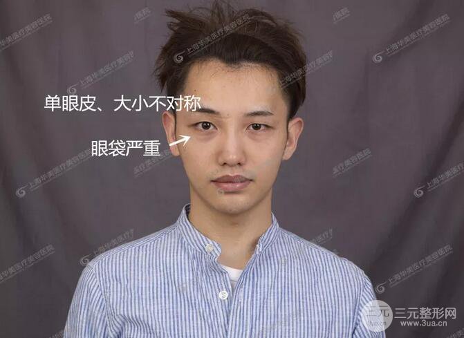 上海華美楊亞益全切雙眼皮案例對(duì)比圖 男女雙眼皮案例混搭