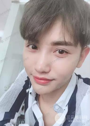 上海華美楊亞益全切雙眼皮案例對(duì)比圖 男女雙眼皮案例混搭