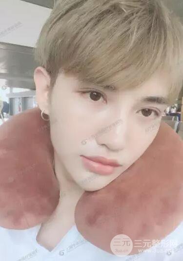 上海華美楊亞益全切雙眼皮案例對(duì)比圖 男女雙眼皮案例混搭