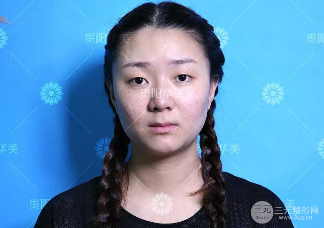 貴陽華美郭宗科全切雙眼皮+假體隆鼻案例前后對比圖 華美員工全臉整形實(shí)錄