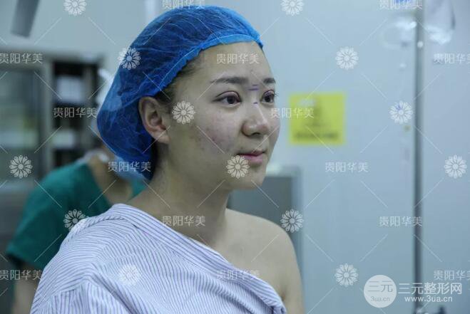 貴陽華美郭宗科全切雙眼皮+假體隆鼻案例前后對比圖 華美員工全臉整形實(shí)錄