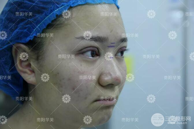 貴陽華美郭宗科全切雙眼皮+假體隆鼻案例前后對比圖 華美員工全臉整形實(shí)錄