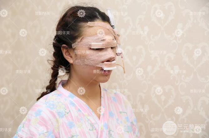 貴陽華美郭宗科全切雙眼皮+假體隆鼻案例前后對比圖 華美員工全臉整形實(shí)錄