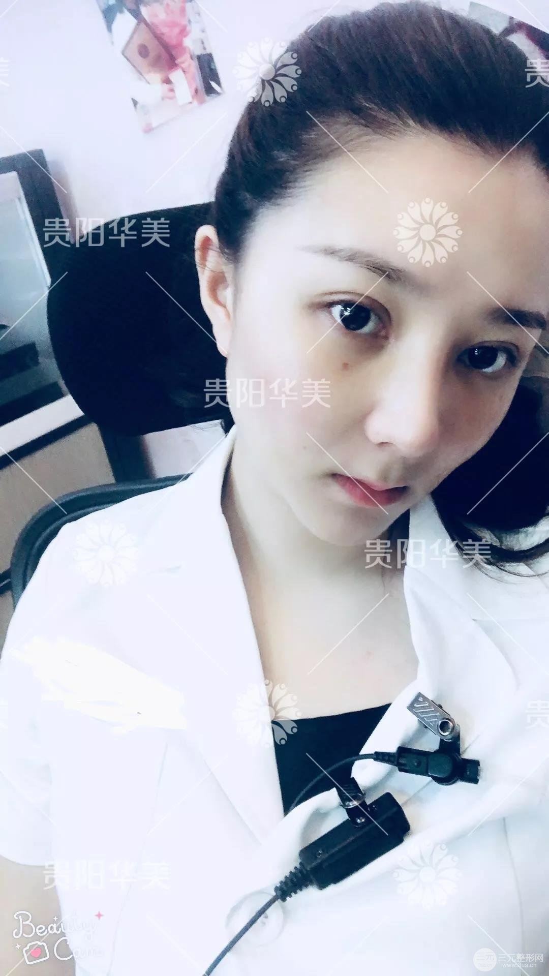 貴陽華美郭宗科全切雙眼皮+假體隆鼻案例前后對比圖 華美員工全臉整形實(shí)錄