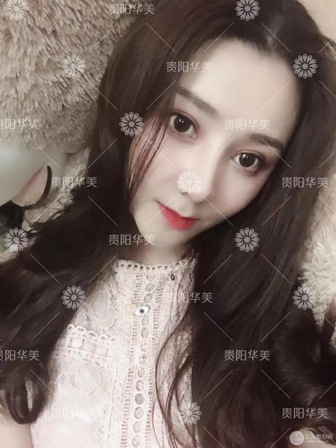 貴陽華美郭宗科全切雙眼皮+假體隆鼻案例前后對比圖 華美員工全臉整形實(shí)錄