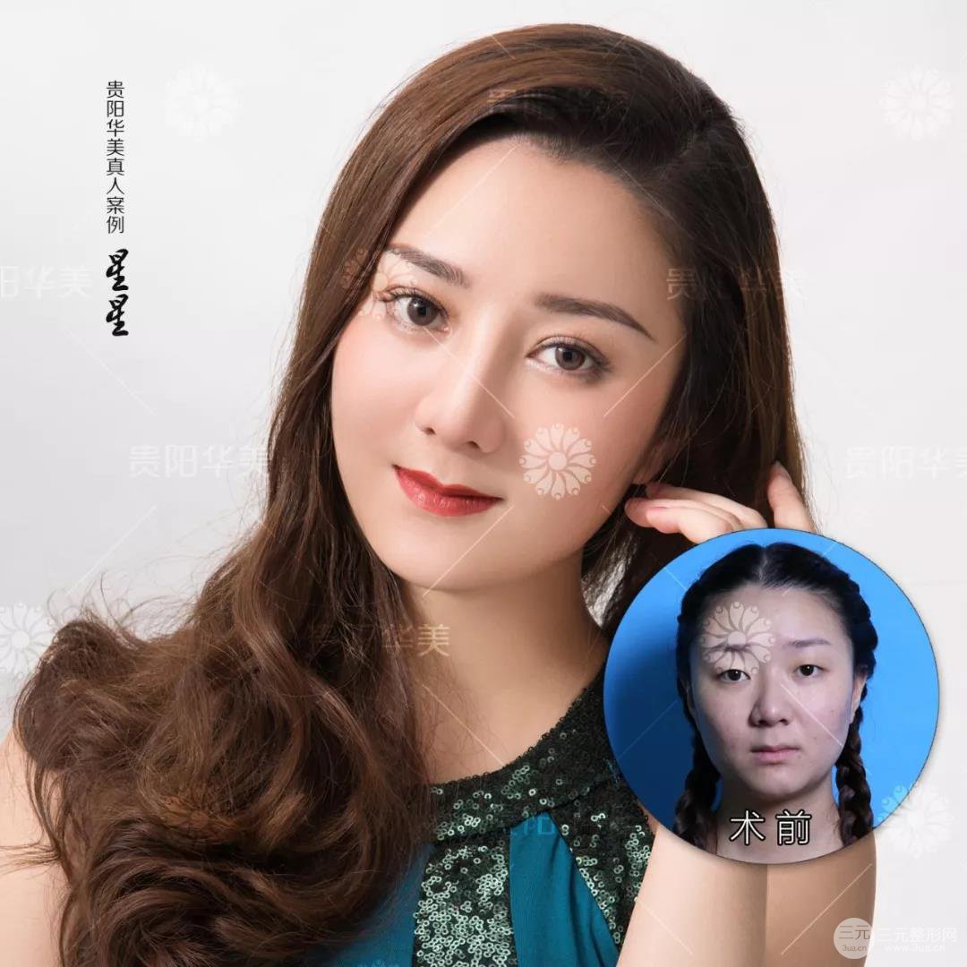 貴陽華美郭宗科全切雙眼皮+假體隆鼻案例前后對比圖 華美員工全臉整形實(shí)錄