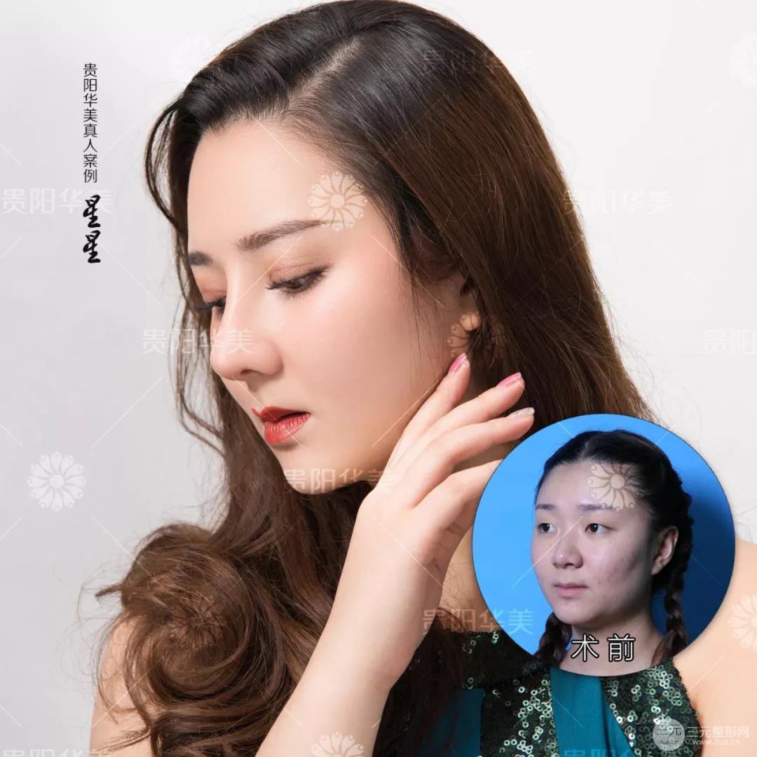 貴陽華美郭宗科全切雙眼皮+假體隆鼻案例前后對比圖 華美員工全臉整形實(shí)錄