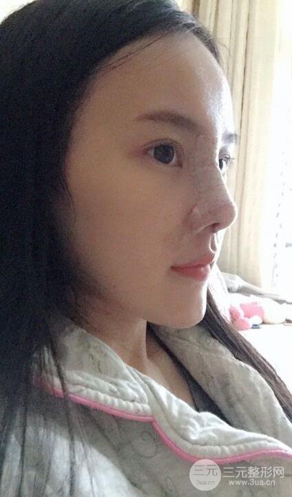 成都大華隆鼻怎么樣?真實(shí)案例前后對(duì)比圖記錄恢復(fù)過程
