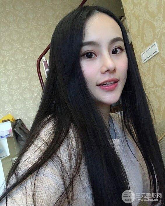 成都大華隆鼻怎么樣?真實(shí)案例前后對(duì)比圖記錄恢復(fù)過程