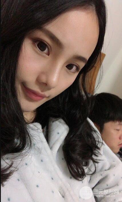 成都大華隆鼻怎么樣?真實(shí)案例前后對(duì)比圖記錄恢復(fù)過程