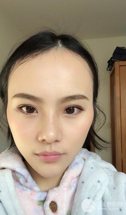 成都大華隆鼻怎么樣?真實(shí)案例前后對(duì)比圖記錄恢復(fù)過程