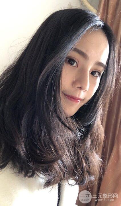 成都大華隆鼻怎么樣?真實(shí)案例前后對(duì)比圖記錄恢復(fù)過程