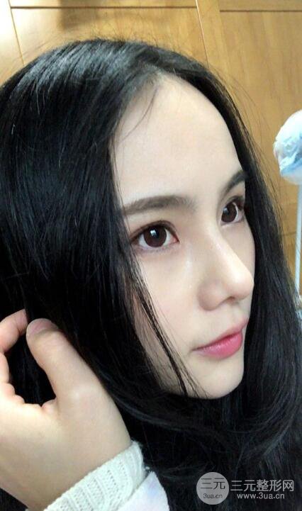 成都大華隆鼻怎么樣?真實(shí)案例前后對(duì)比圖記錄恢復(fù)過程