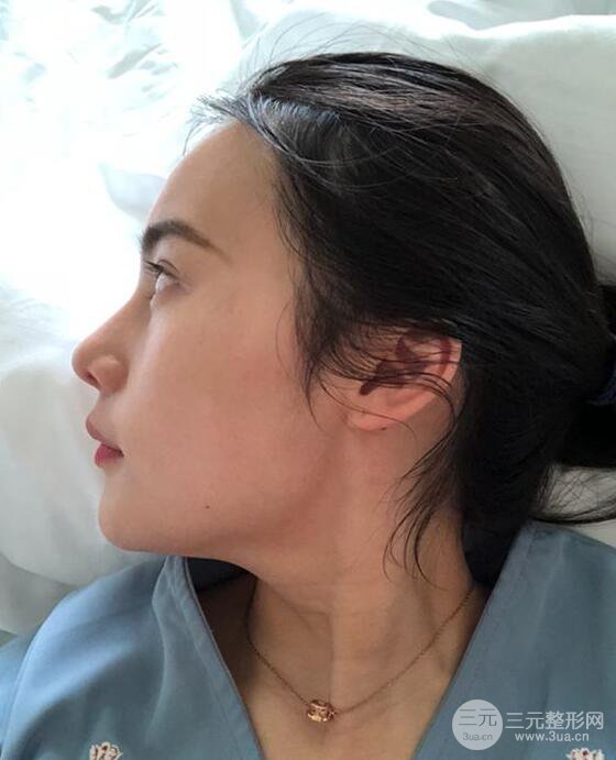 成都大華隆鼻怎么樣?真實(shí)案例前后對(duì)比圖記錄恢復(fù)過程