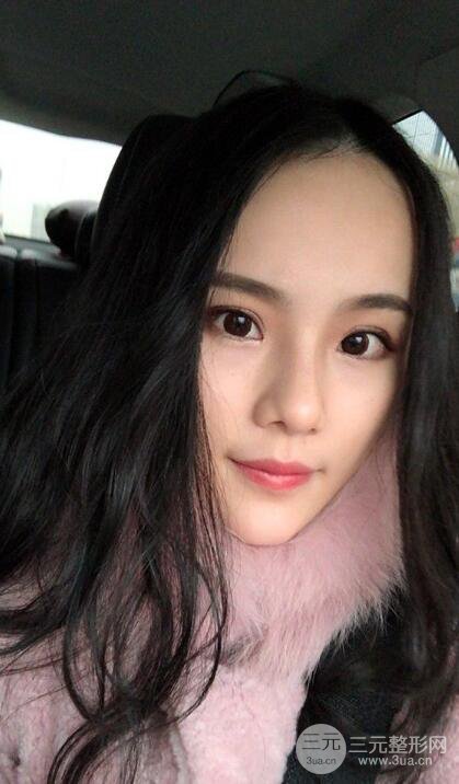 成都大華隆鼻怎么樣?真實(shí)案例前后對(duì)比圖記錄恢復(fù)過程