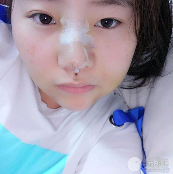 合肥壹加壹甘泉涌軟骨隆鼻前后對比圖|內(nèi)附真人案例恢復(fù)前過程
