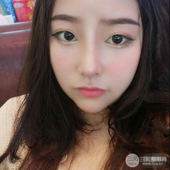 合肥壹加壹甘泉涌軟骨隆鼻前后對比圖|內(nèi)附真人案例恢復(fù)前過程