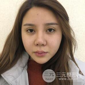 昆明吳氏嘉美李明硅膠隆鼻前后對比圖恢復心情小札