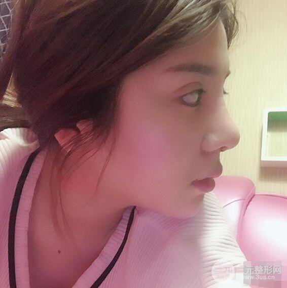 昆明吳氏嘉美李明硅膠隆鼻前后對比圖恢復心情小札