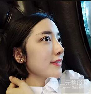 杭州格萊美張樹功假體隆鼻前后對(duì)比圖|內(nèi)附恢復(fù)心情變化哦