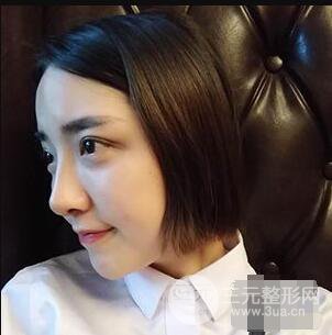 杭州格萊美張樹功假體隆鼻前后對(duì)比圖|內(nèi)附恢復(fù)心情變化哦