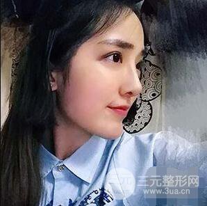 杭州格萊美張樹功假體隆鼻前后對(duì)比圖|內(nèi)附恢復(fù)心情變化哦