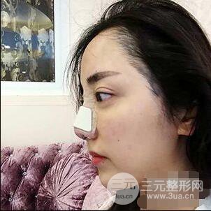 杭州格萊美張樹功假體隆鼻前后對(duì)比圖|內(nèi)附恢復(fù)心情變化哦