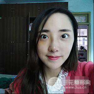 杭州格萊美張樹功假體隆鼻前后對(duì)比圖|內(nèi)附恢復(fù)心情變化哦