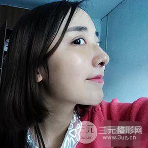 杭州格萊美張樹功假體隆鼻前后對(duì)比圖|內(nèi)附恢復(fù)心情變化哦