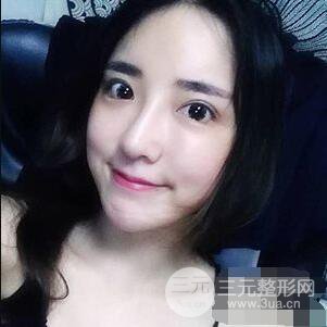 杭州格萊美張樹功假體隆鼻前后對(duì)比圖|內(nèi)附恢復(fù)心情變化哦