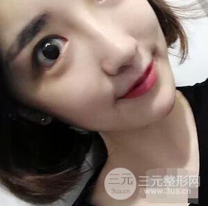 杭州格萊美張樹功假體隆鼻前后對(duì)比圖|內(nèi)附恢復(fù)心情變化哦