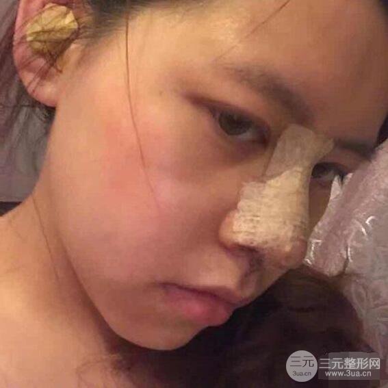 重慶華美何春濤硅膠隆鼻前后對比圖 內(nèi)附恢復(fù)心情小札